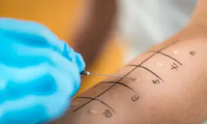 Ręka z zaznaczonymi polami do testów alergicznych skórnych. Igła wprowadza substancję pod skórę.
