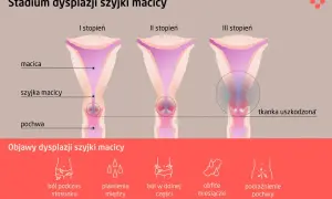 Grafika pokazuje stadia dysplazji szyjki macicy, od I do III stopnia. Czy dysplazja to rak? Nie, to stan przedrakowy.