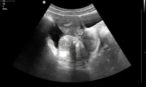 USG dopochwowe: obraz sugerujący raka jajnika z widocznymi wymiarami 5.28 cm i 3.79 cm.