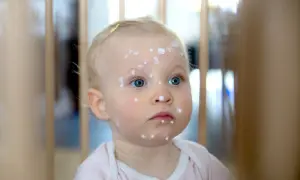 Małe dziecko z niebieskimi oczami ma na twarzy i szyi kropki, które świadczą o ospie wietrznej.