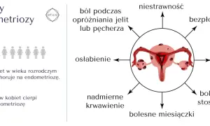 Objawy endometriozy: ból, bezpłodność, mdłości, osłabienie, niestrawność, nadmierne krwawienie, bolesne miesiączki i stosunki. 1 na 10 kobiet choruje.