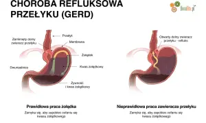 Ilustracja pokazuje prawidłowe i nieprawidłowe działanie zwieracza przełyku, wyjaśniając co na reflux.