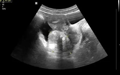 USG dopochwowe: obraz sugerujący raka jajnika z widocznymi wymiarami 5.28 cm i 3.79 cm.