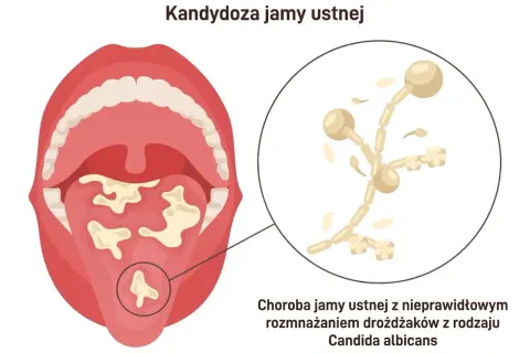 Obraz przedstawia jamę ustną z białymi nalotami na języku i podniebieniu, co jest jednym z objawów kandydozy. Powiększony fragment pokazuje grzyb Candida albicans.