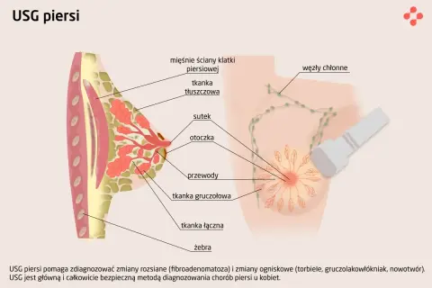 USG piersi pomaga wykryć zmiany w tkankach piersi, takie jak torbiele czy gruczolakowłókniaki.