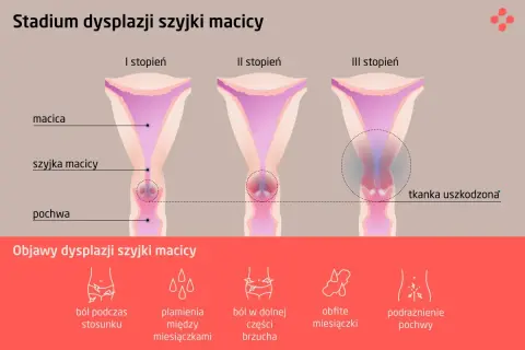 Grafika pokazuje stadia dysplazji szyjki macicy, od I do III stopnia. Czy dysplazja to rak? Nie, to stan przedrakowy.