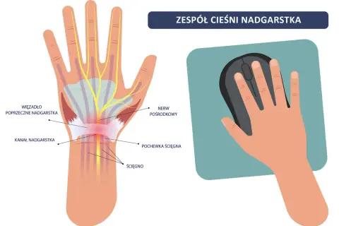 Ilustracja pokazuje zespół **cieśni nadgarstka**. Widoczny jest kanał nadgarstka, nerw pośrodkowy i ścięgna. Po prawej stronie dłoń trzyma myszkę komputerową.