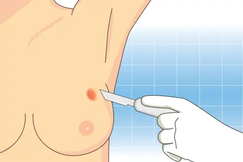 Dłoń w rękawiczce medycznej trzyma skalpel, zbliżając się do zmiany na piersi. Ilustracja pokazuje moment przed pobraniem wycinka, odpowiadając na pytanie: ile trwa biopsja.