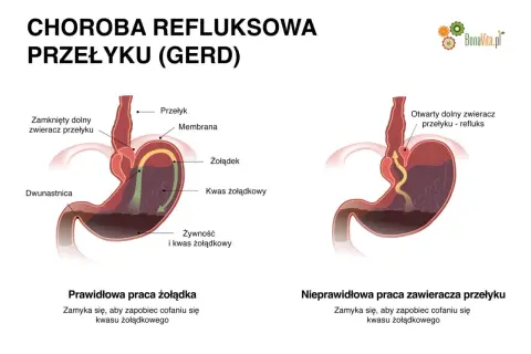 Ilustracja pokazuje prawidłowe i nieprawidłowe działanie zwieracza przełyku, wyjaśniając co na reflux.