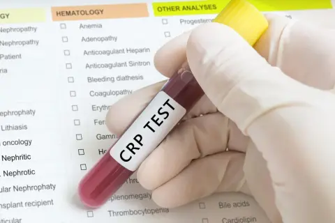 Ręka w rękawiczce trzyma probówkę z krwią do badania CRP. Wynik badania CRP norma jest kluczowy w diagnostyce stanu zapalnego.
