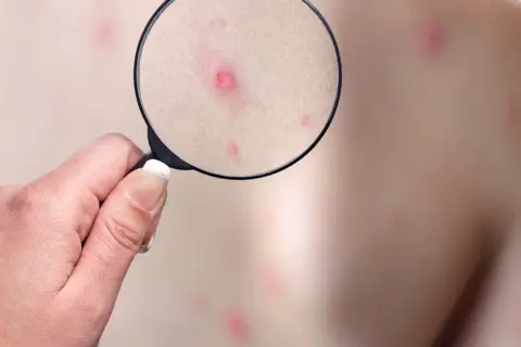 Powiększenie ukazuje zaczerwienione krostki na skórze, sugerujące ospa zarażanie.
