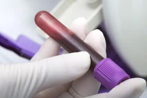Ręka w białej rękawiczce trzyma probówkę z krwią. Badanie fibrynogen w ciąży jest kluczowe dla zdrowia matki i dziecka.