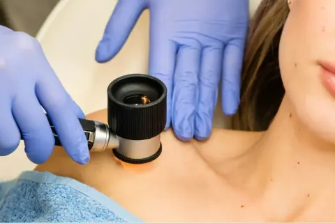 Dermatoskopia co to? Lekarz w rękawiczkach bada pieprzyki pacjentki dermatoskopem.