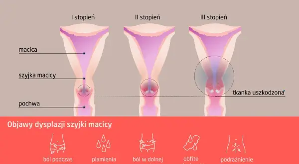 Grafika pokazuje stadia dysplazji szyjki macicy, od I do III stopnia. Czy dysplazja to rak? Nie, to stan przedrakowy.