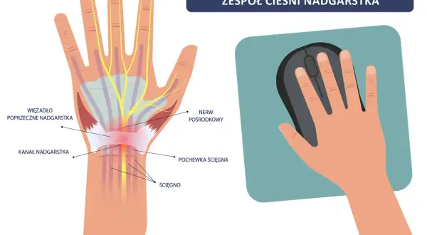 Ilustracja pokazuje zespół **cieśni nadgarstka**. Widoczny jest kanał nadgarstka, nerw pośrodkowy i ścięgna. Po prawej stronie dłoń trzyma myszkę komputerową.