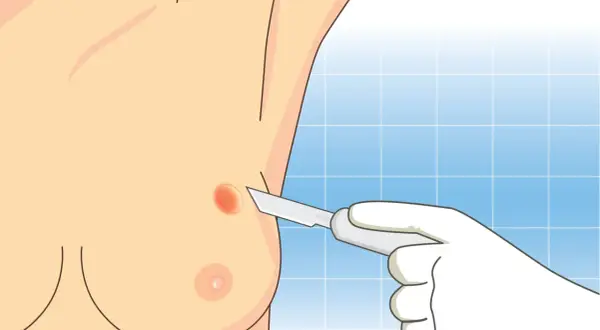 Dłoń w rękawiczce medycznej trzyma skalpel, zbliżając się do zmiany na piersi. Ilustracja pokazuje moment przed pobraniem wycinka, odpowiadając na pytanie: ile trwa biopsja.