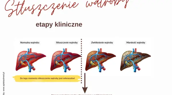 Grafika pokazuje etapy stłuszczenia wątroby: od normalnej, przez stłuszczenie (które jest odwracalne!), zwłóknienie, aż do marskości.