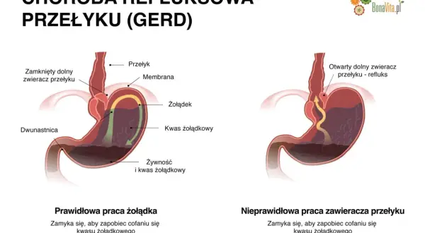 Ilustracja pokazuje prawidłowe i nieprawidłowe działanie zwieracza przełyku, wyjaśniając co na reflux.