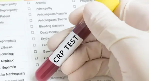 Ręka w rękawiczce trzyma probówkę z krwią do badania CRP. Wynik badania CRP norma jest kluczowy w diagnostyce stanu zapalnego.