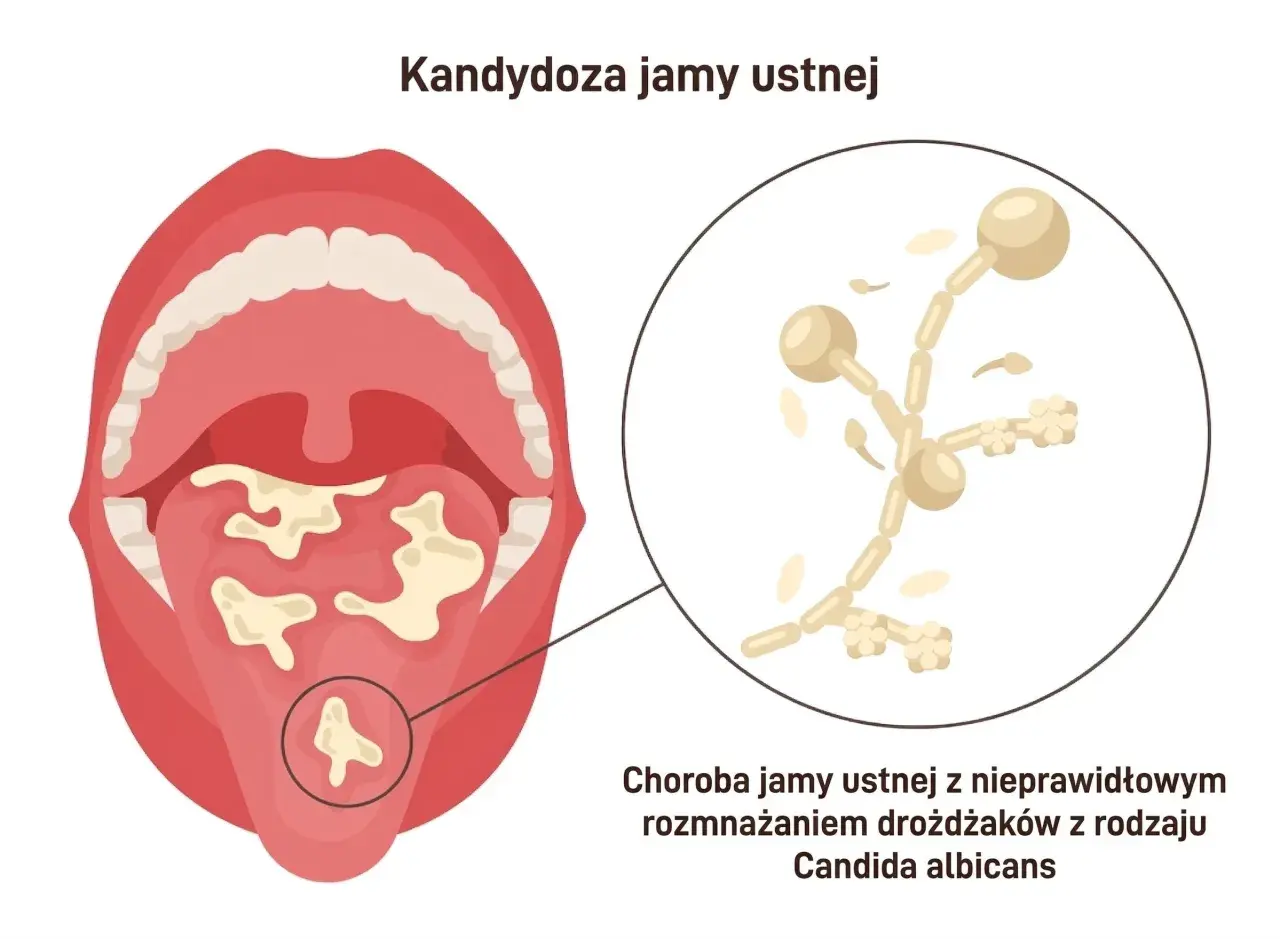 Obraz przedstawia jamę ustną z białymi nalotami na języku i podniebieniu, co jest jednym z objawów kandydozy. Powiększony fragment pokazuje grzyb Candida albicans.