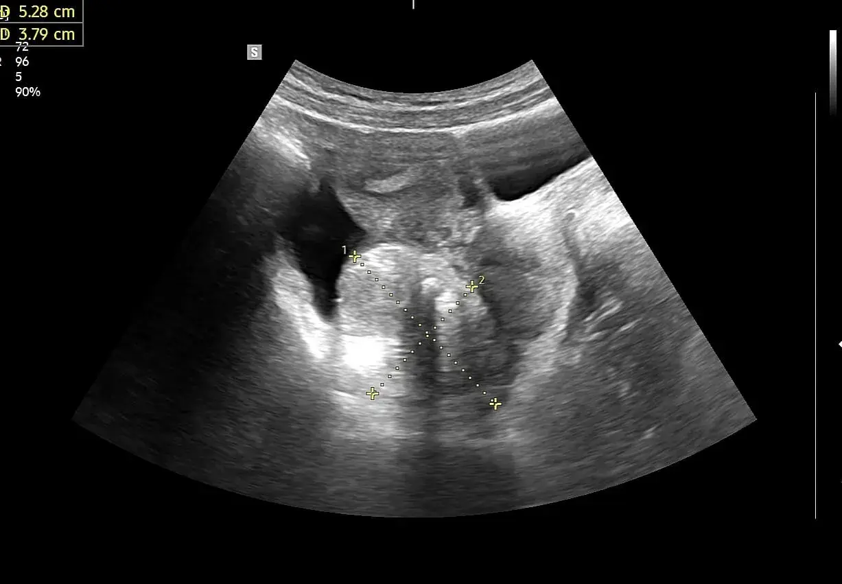 USG dopochwowe: obraz sugerujący raka jajnika z widocznymi wymiarami 5.28 cm i 3.79 cm.