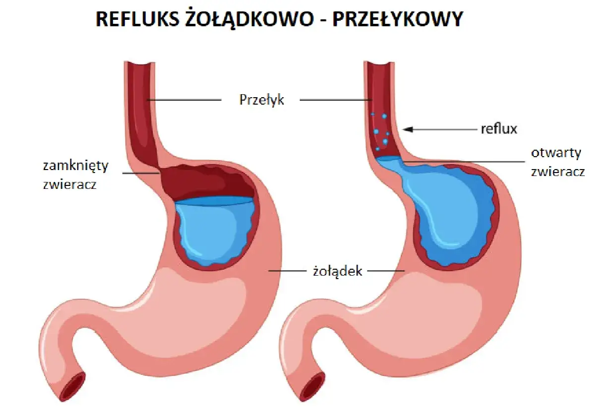 Schemat żołądka i przełyku. Po lewej zamknięty zwieracz, po prawej refluks żołądkowo-przełykowy z otwartym zwieraczem.