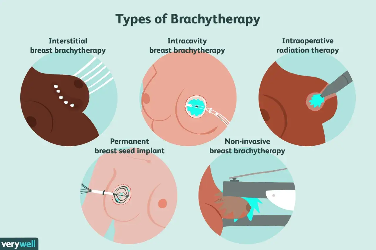 R&oacute;żne rodzaje brachyterapii piersi: implantacja ziaren, terapia dopochwowa, śr&oacute;dtkankowa, śr&oacute;doperacyjna i nieinwazyjna.