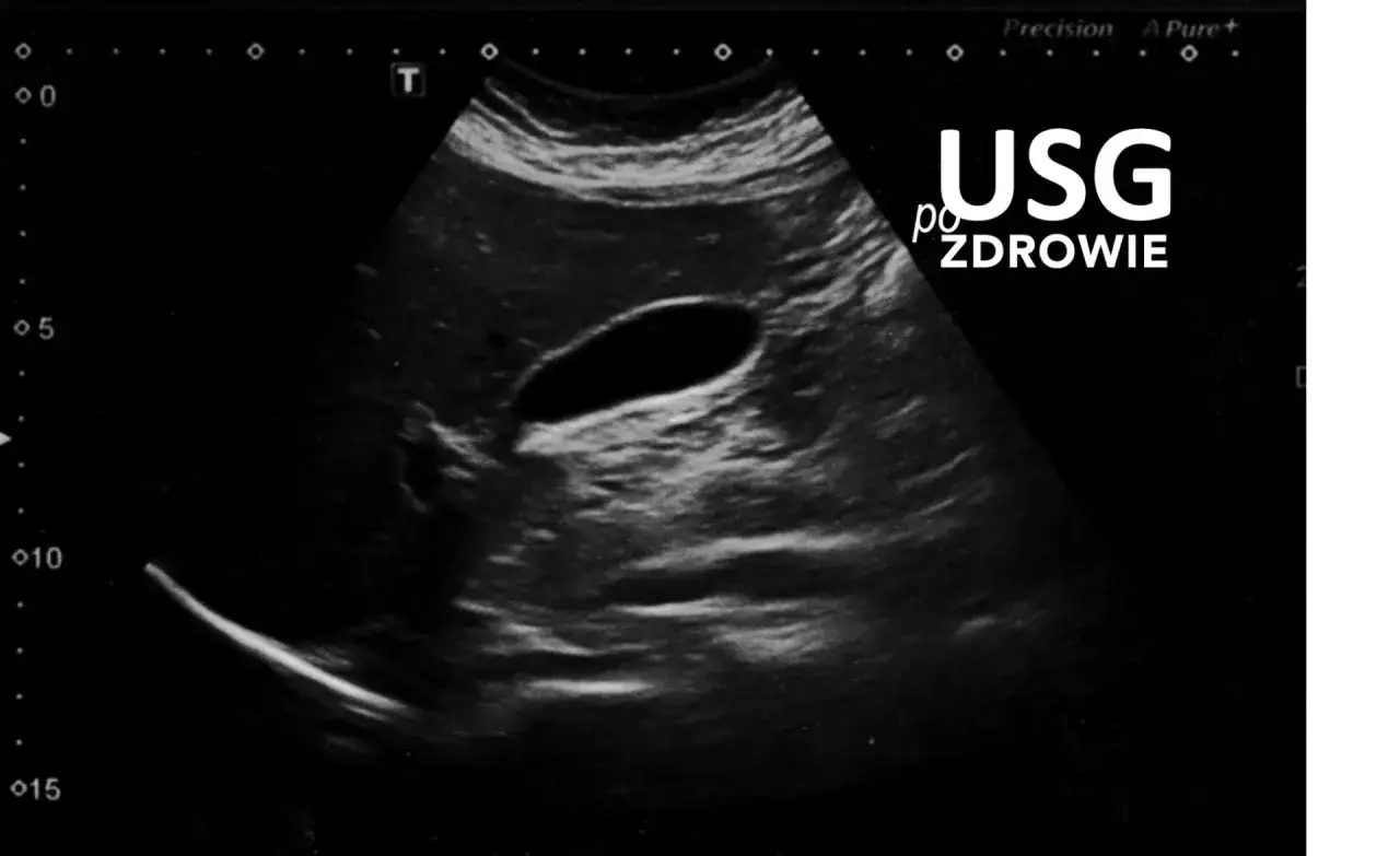 USG: polip woreczka ż&oacute;łciowego, kt&oacute;ry może być powiązany z nadużywaniem alkoholu.