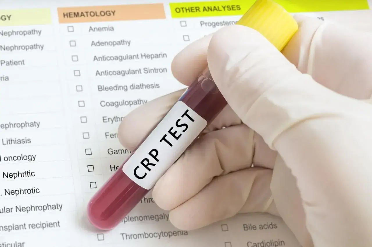 Ręka w rękawiczce trzyma prob&oacute;wkę z krwią do badania CRP. Wynik badania CRP norma jest kluczowy w diagnostyce stanu zapalnego.