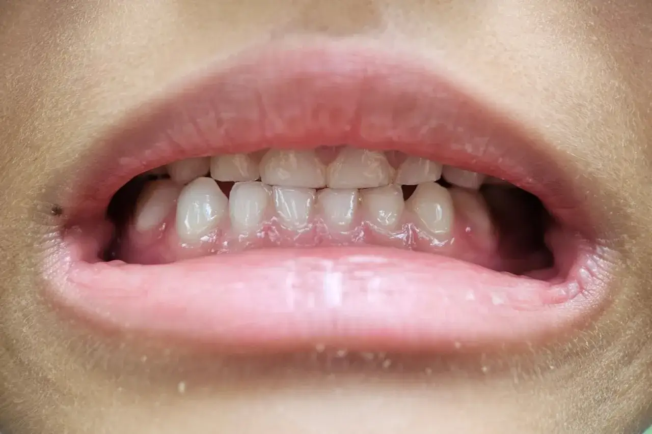 Usta z widocznymi zębami i dziąsłami. Czyżby to był metaliczny posmak w ustach po wizycie u dentysty?