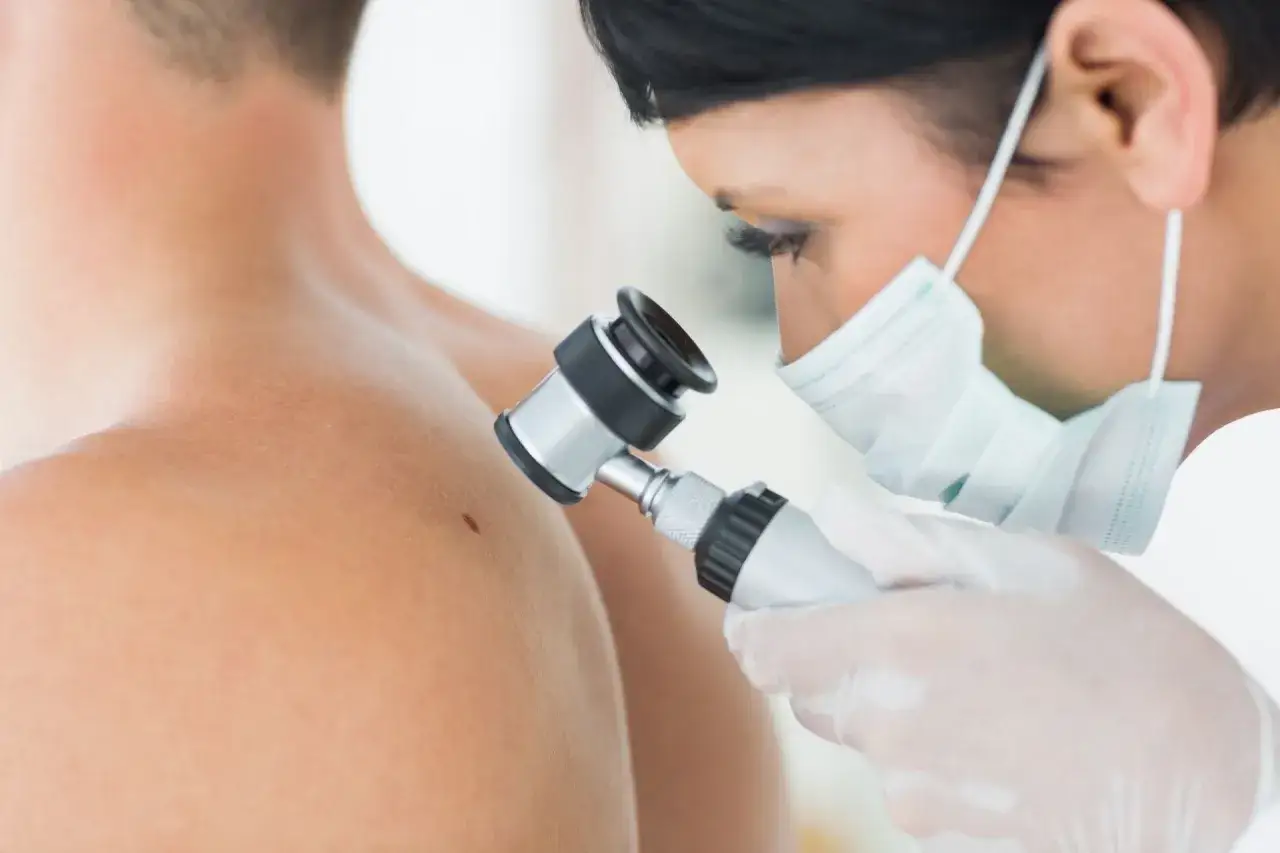 Lekarz bada pieprzyk dermatoskopem. Dowiedz się, co to dermatoskopia i jak przebiega badanie.
