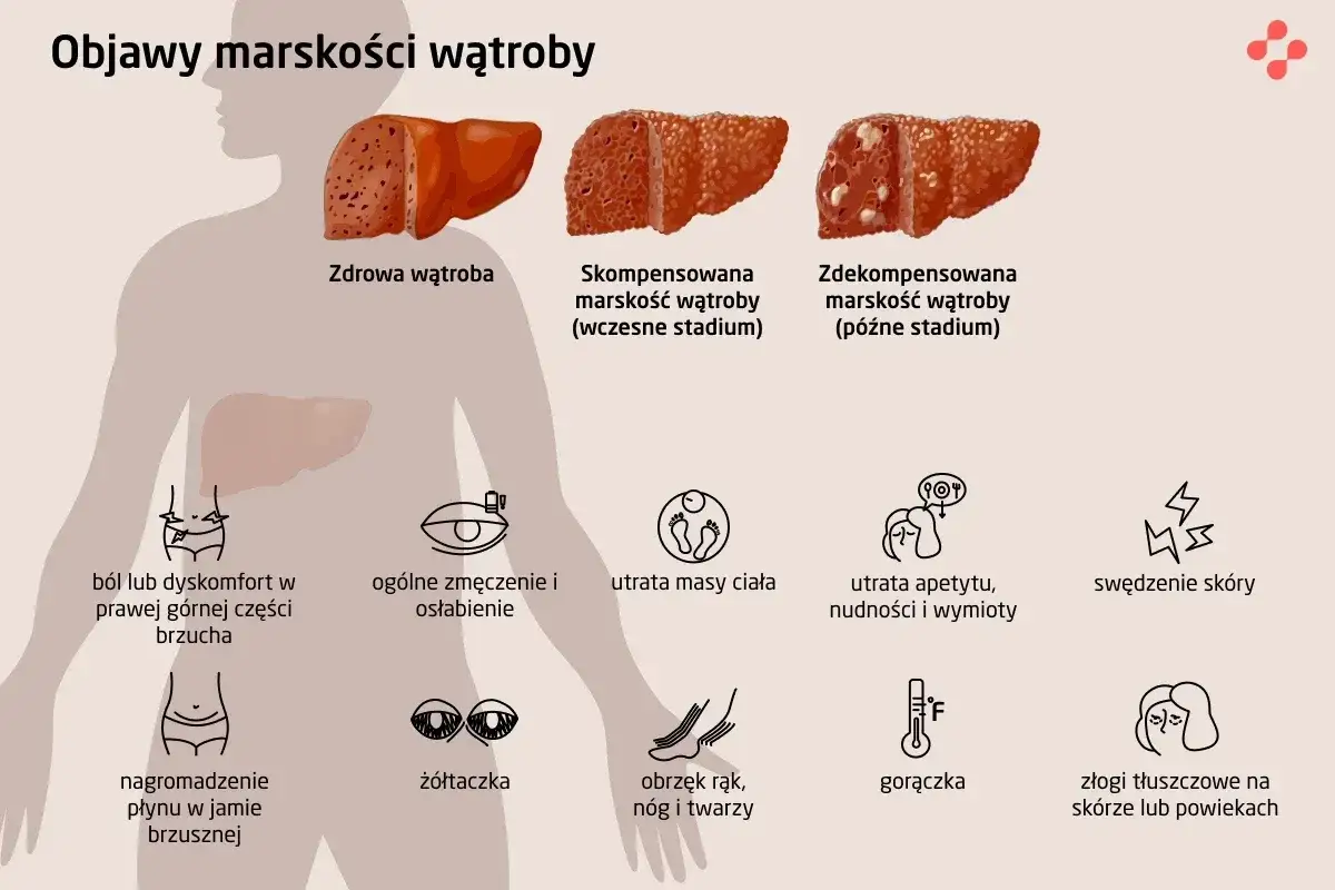 Ilustracja pokazuje, gdzie jest wątroba i jej objawy marskości: b&oacute;l brzucha, zmęczenie, utrata masy ciała, ż&oacute;łtaczka, obrzęki, gorączka i zmiany sk&oacute;rne.