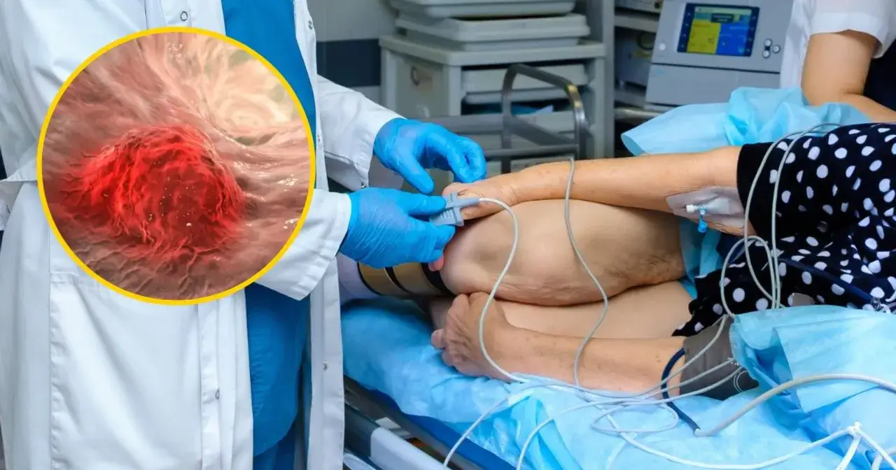 Lekarz w rękawiczkach bada pacjenta, kt&oacute;remu grozi rak odbytu. W powiększeniu widoczny jest guz nowotworowy.