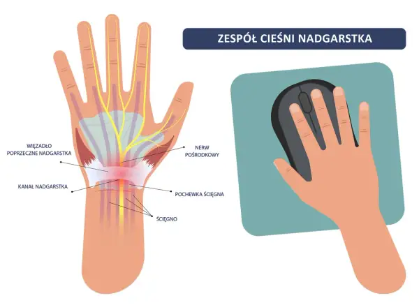 Ilustracja pokazuje zespół **cieśni nadgarstka**. Widoczny jest kanał nadgarstka, nerw pośrodkowy i ścięgna. Po prawej stronie dłoń trzyma myszkę komputerową.