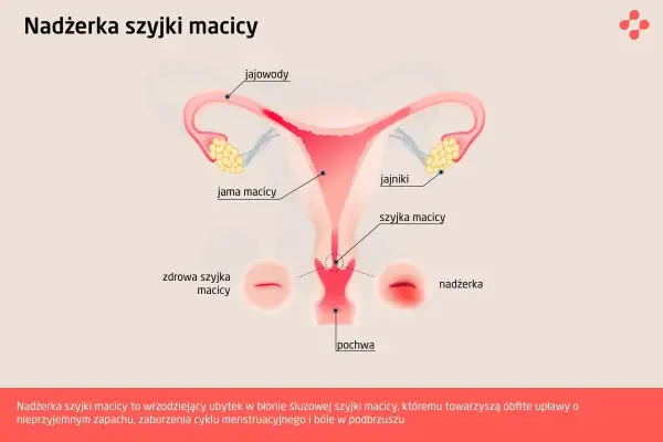 Schemat układu rozrodczego kobiety. Pokazuje nadżerkę szyjki macicy, wrzodziejący ubytek.