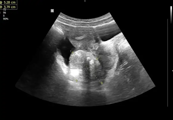 USG dopochwowe: obraz sugerujący raka jajnika z widocznymi wymiarami 5.28 cm i 3.79 cm.
