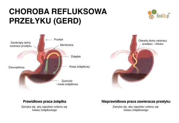 Ilustracja pokazuje prawidłowe i nieprawidłowe działanie zwieracza przełyku, wyjaśniając co na reflux.
