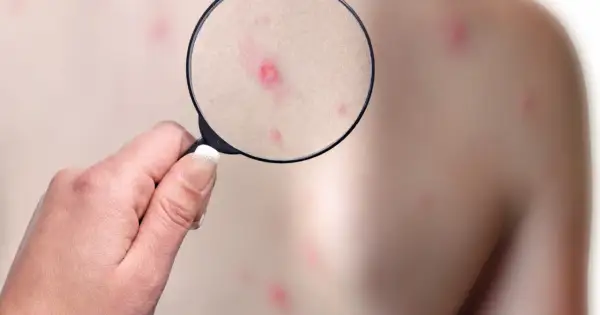 Powiększenie ukazuje zaczerwienione krostki na skórze, sugerujące ospa zarażanie.